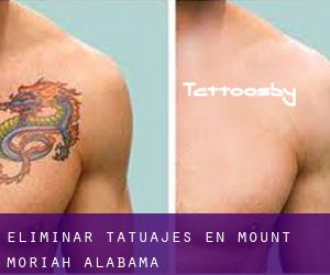 Eliminar tatuajes en Mount Moriah (Alabama)