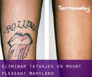 Eliminar tatuajes en Mount Pleasant (Maryland)