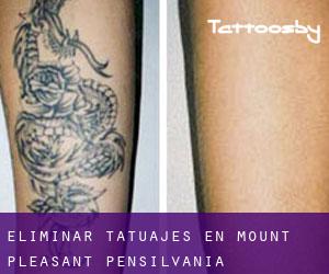 Eliminar tatuajes en Mount Pleasant (Pensilvania)