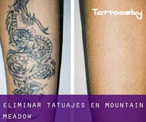 Eliminar tatuajes en Mountain Meadow