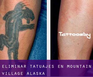Eliminar tatuajes en Mountain Village (Alaska)