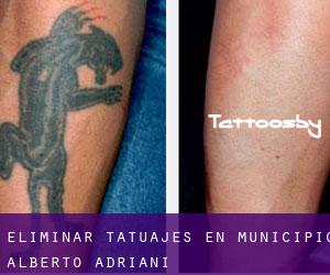 Eliminar tatuajes en Municipio Alberto Adriani