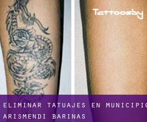 Eliminar tatuajes en Municipio Arismendi (Barinas)