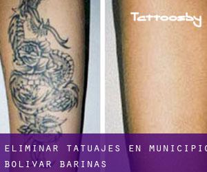 Eliminar tatuajes en Municipio Bolívar (Barinas)