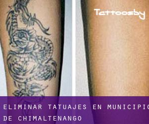 Eliminar tatuajes en Municipio de Chimaltenango