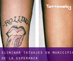 Eliminar tatuajes en Municipio de La Esperanza