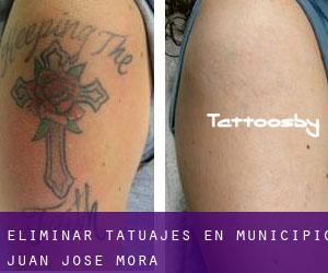 Eliminar tatuajes en Municipio Juan José Mora