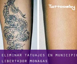 Eliminar tatuajes en Municipio Libertador (Monagas)