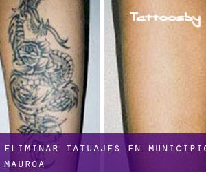 Eliminar tatuajes en Municipio Mauroa