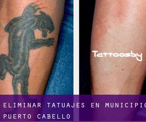 Eliminar tatuajes en Municipio Puerto Cabello
