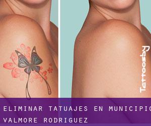 Eliminar tatuajes en Municipio Valmore Rodríguez