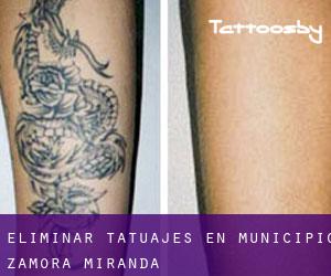 Eliminar tatuajes en Municipio Zamora (Miranda)