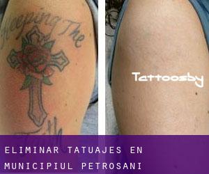 Eliminar tatuajes en Municipiul Petroşani