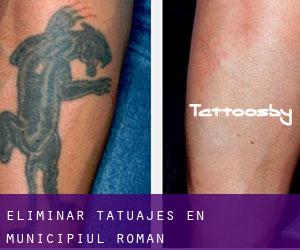 Eliminar tatuajes en Municipiul Roman