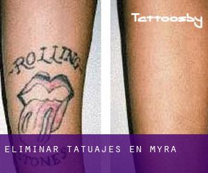 Eliminar tatuajes en Myra