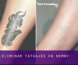 Eliminar tatuajes en Nemby