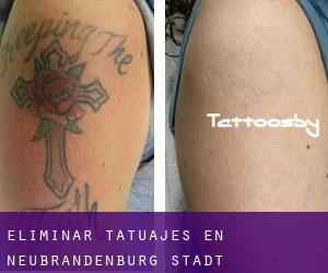 Eliminar tatuajes en Neubrandenburg Stadt