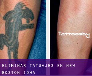 Eliminar tatuajes en New Boston (Iowa)