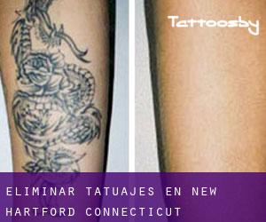 Eliminar tatuajes en New Hartford (Connecticut)
