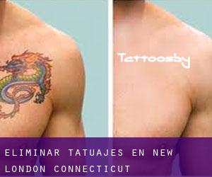 Eliminar tatuajes en New London (Connecticut)