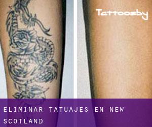 Eliminar tatuajes en New Scotland