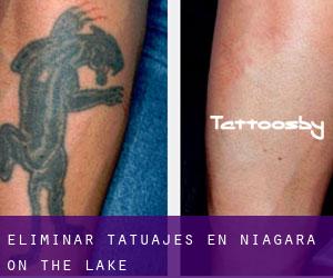 Eliminar tatuajes en Niagara-on-the-Lake