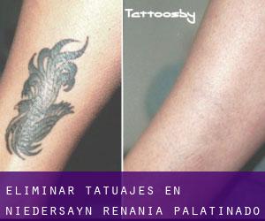 Eliminar tatuajes en Niedersayn (Renania-Palatinado)