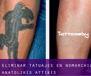 Eliminar tatuajes en Nomarchía Anatolikís Attikís