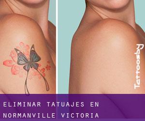 Eliminar tatuajes en Normanville (Victoria)