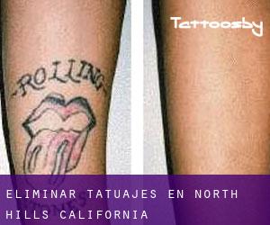 Eliminar tatuajes en North Hills (California)