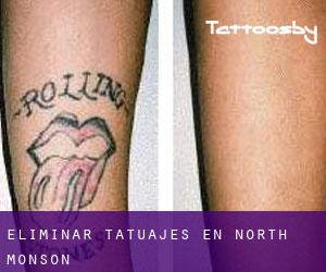 Eliminar tatuajes en North Monson