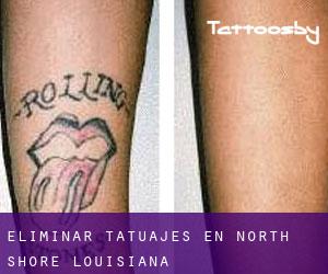 Eliminar tatuajes en North Shore (Louisiana)