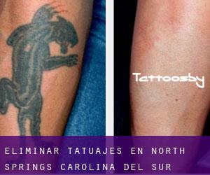 Eliminar tatuajes en North Springs (Carolina del Sur)