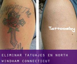 Eliminar tatuajes en North Windham (Connecticut)