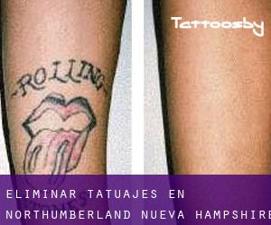 Eliminar tatuajes en Northumberland (Nueva Hampshire)