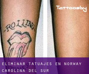 Eliminar tatuajes en Norway (Carolina del Sur)