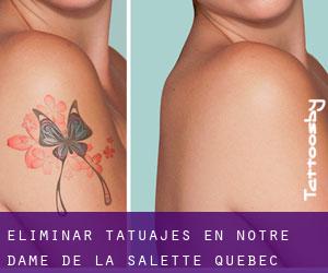 Eliminar tatuajes en Notre-Dame-de-la-Salette (Quebec)