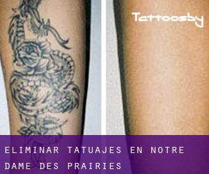Eliminar tatuajes en Notre-Dame-des-Prairies