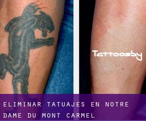 Eliminar tatuajes en Notre-Dame-du-Mont-Carmel