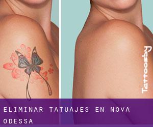 Eliminar tatuajes en Nova Odessa