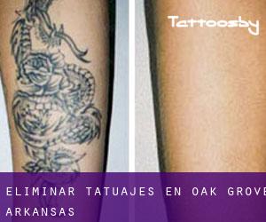 Eliminar tatuajes en Oak Grove (Arkansas)