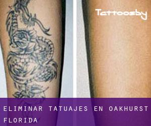 Eliminar tatuajes en Oakhurst (Florida)
