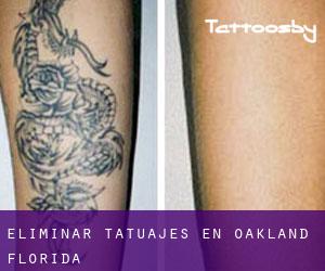 Eliminar tatuajes en Oakland (Florida)