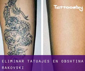 Eliminar tatuajes en Obshtina Rakovski