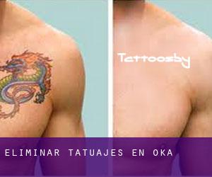 Eliminar tatuajes en Oka