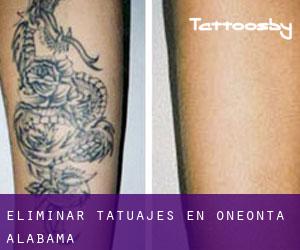 Eliminar tatuajes en Oneonta (Alabama)