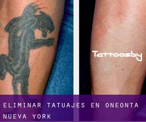 Eliminar tatuajes en Oneonta (Nueva York)