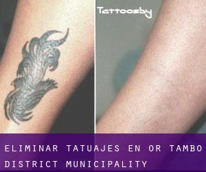 Eliminar tatuajes en OR Tambo District Municipality