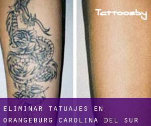 Eliminar tatuajes en Orangeburg (Carolina del Sur)