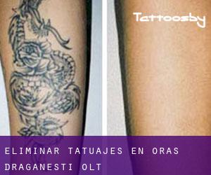 Eliminar tatuajes en Oraş Drãgãneşti-Olt
